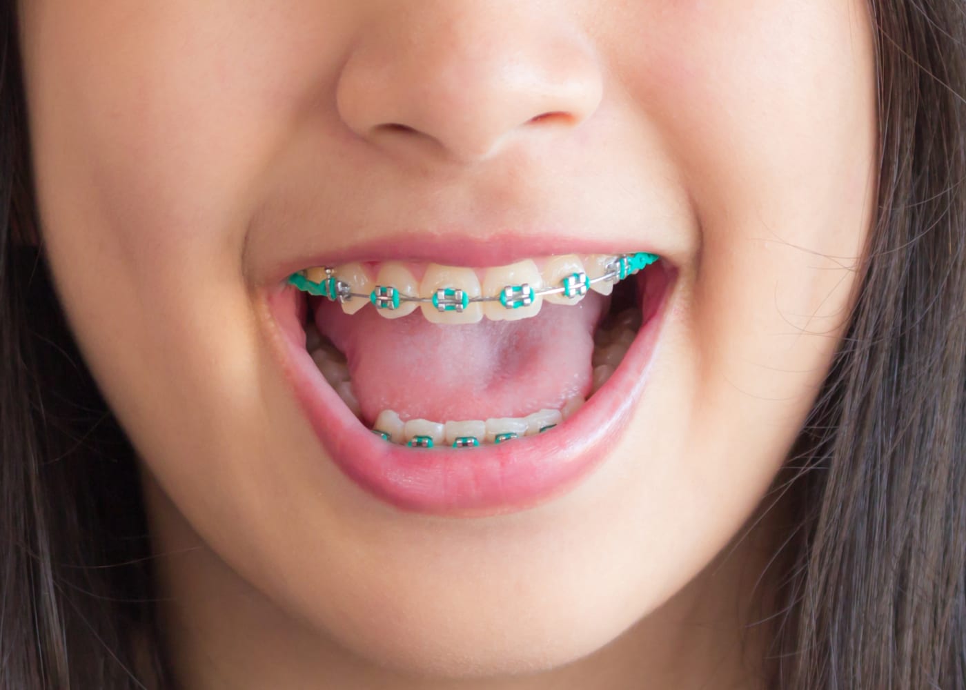 Prep your child for getting braces: what to say and do as a parent